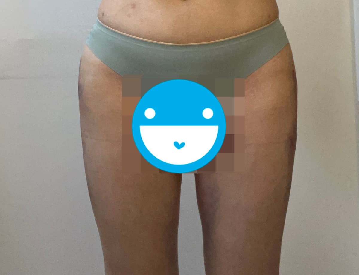 我做了骨盆脂肪移植~~