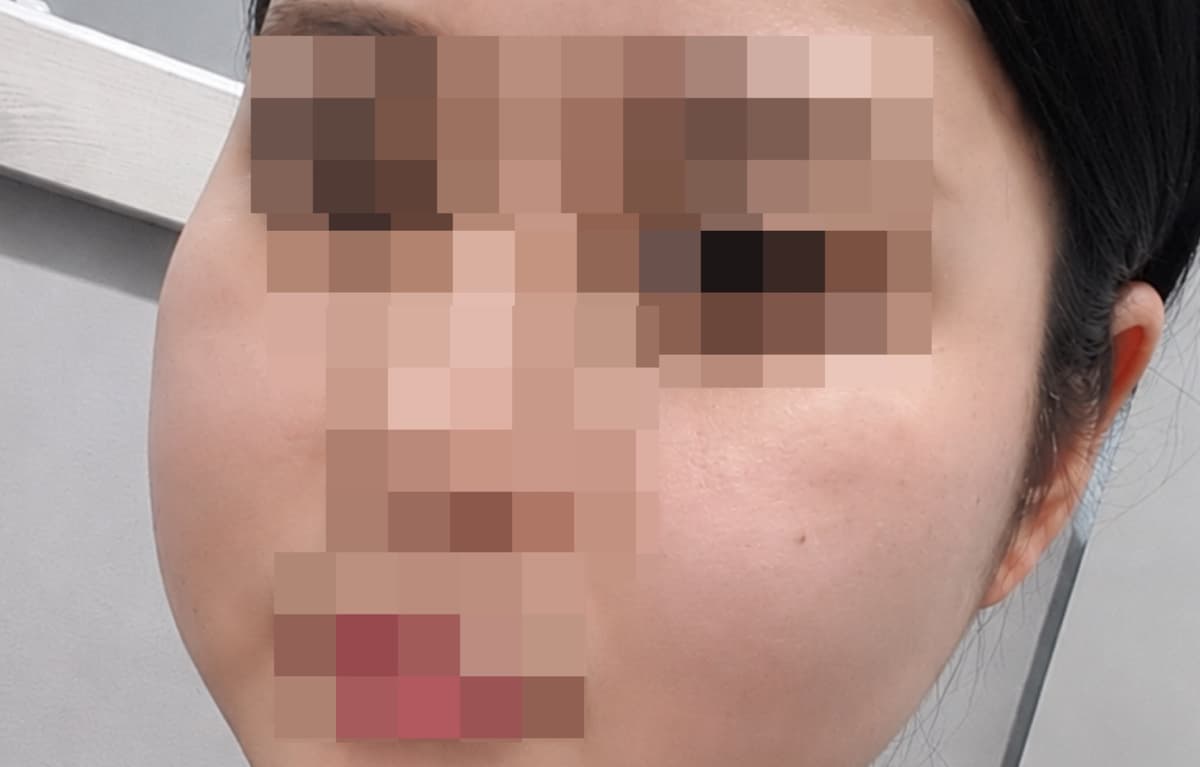 我做了颧骨吸脂和脸颊吸脂！