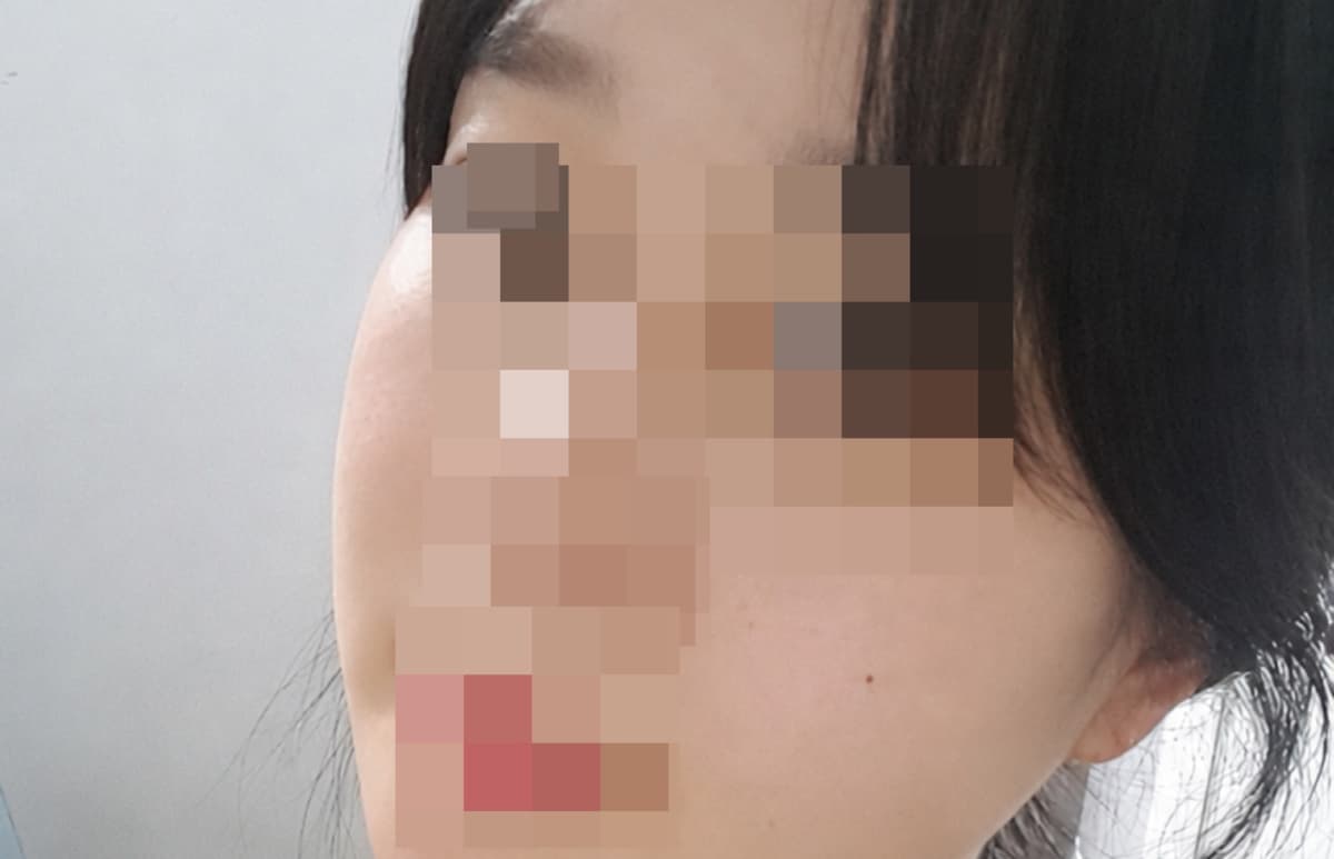 我做了颧骨吸脂和脸颊吸脂！