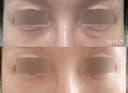 눈밑 결절, 눈밑결절제거로 해결했어요