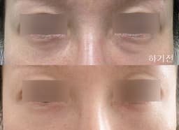 Resolví mis nódulos debajo de los ojos con una extirpación de nódulos debajo de los ojos.