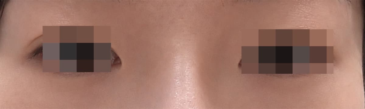 애교살 미세지방이식 받았어요!