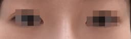 J'ai eu recours à une micro-injection de graisse pour mes poches sous les yeux !