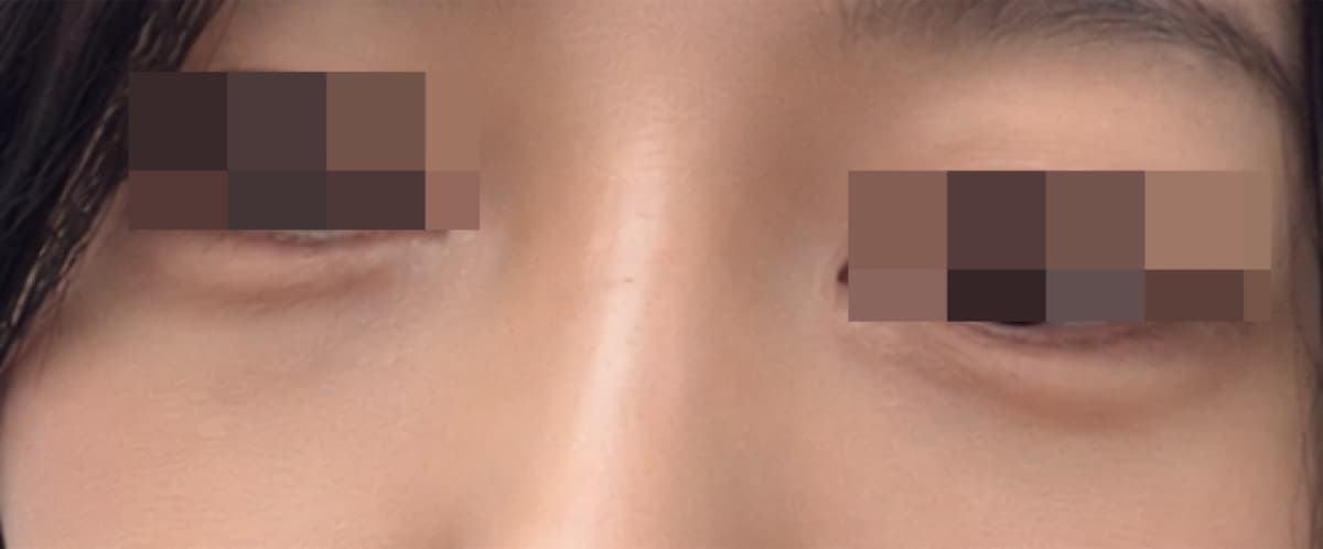 애교살 미세지방이식 받았어요!