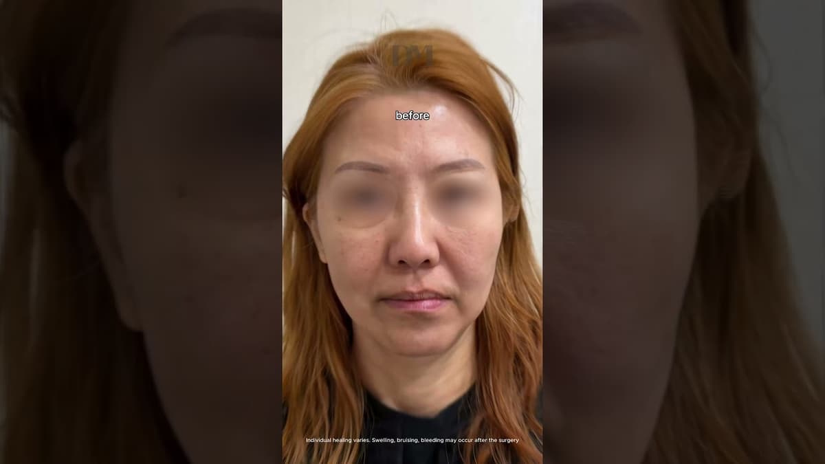 POV: What a face lift in Korea can look like #facelift #necklift #koreaplasticsurgery #kbeauty #fyp