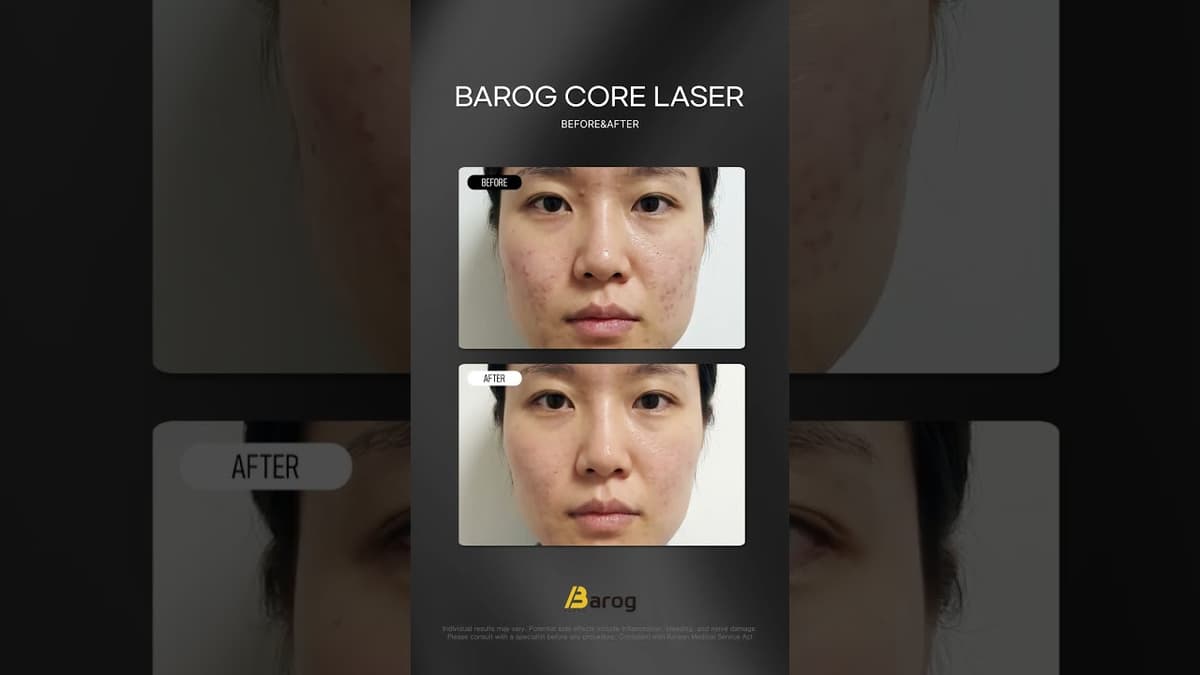 [Gangnam Clinic Seoul: Barog Core Laser Before & After✨]