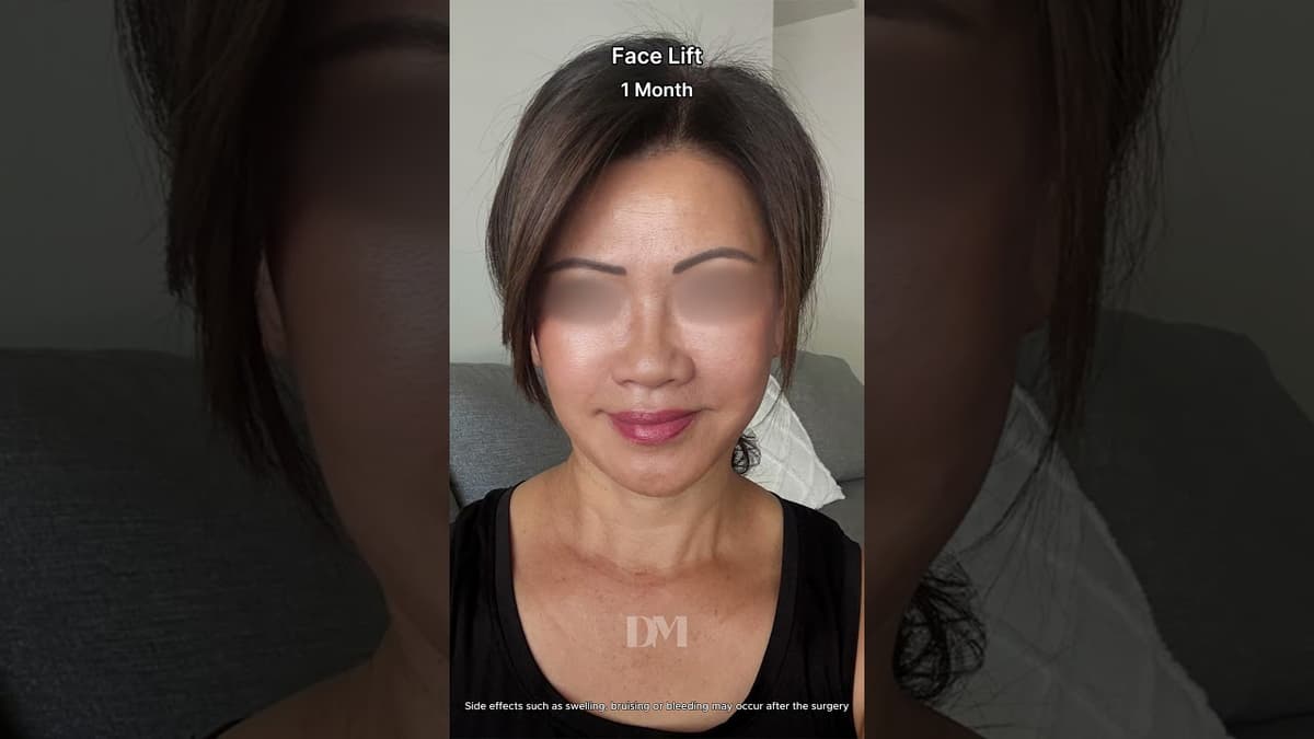 #facelift #surgery #result DM Plastic Surgery, Dr. Yoo, who is a face lift specialist. #necklift