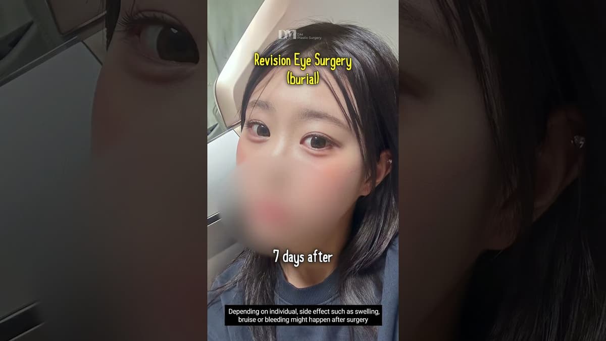 #Revisionsurgery #Eyesurgery , do you think I chose right clinic?  #viral #trend #korea #fyp #seoul