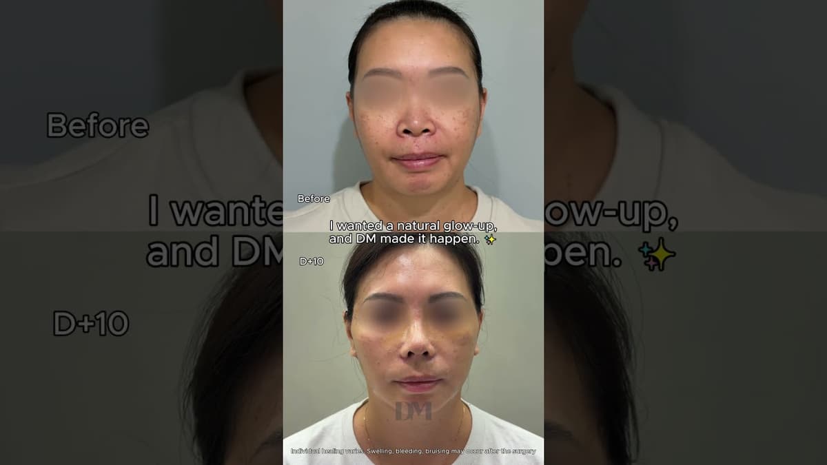 NATURAL, NOT DRAMATIC ✨ #lifeinkorea #fyp #trend #viral #facelift #necklift #korea #seoul #tripkorea