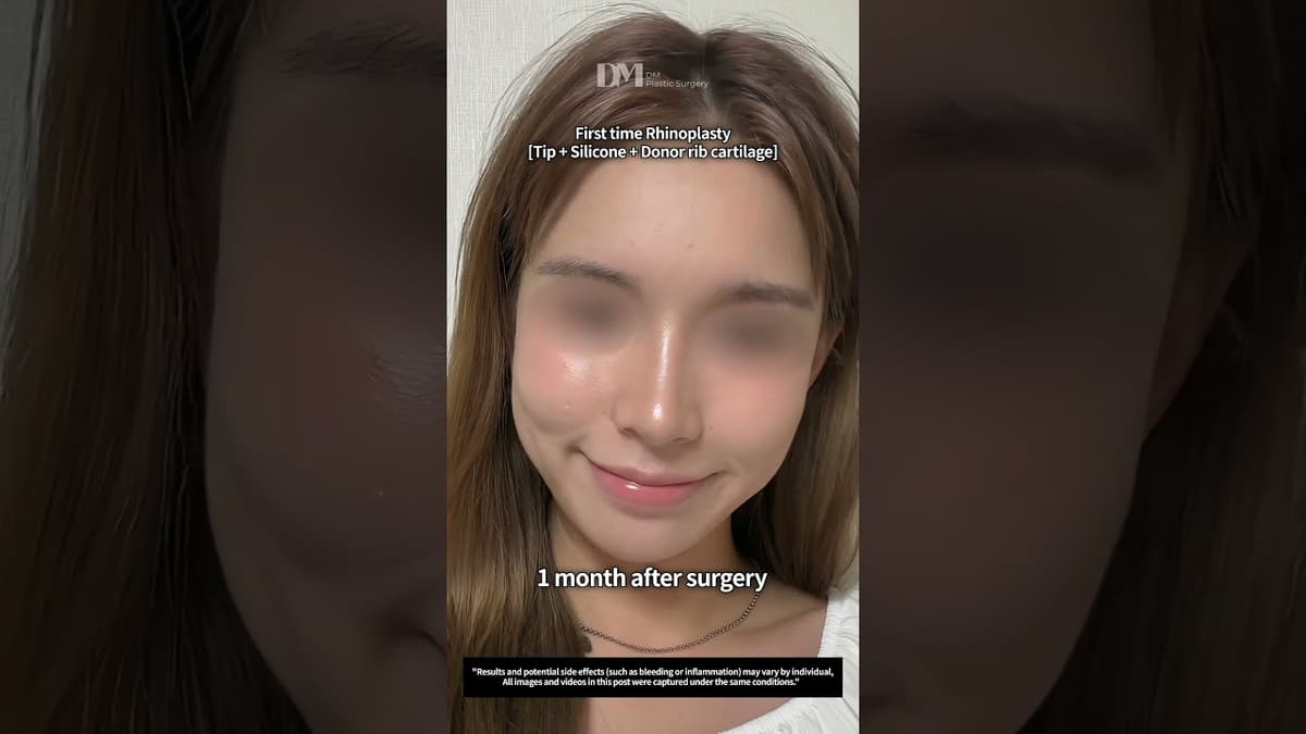 First #rhinoplasty done in Korea #kbeauty #fyp #viralshorts #trend #nosejob #nosesurgery #transition