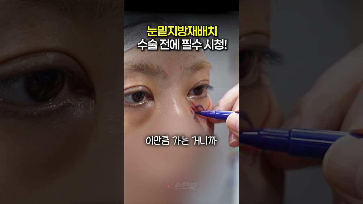 눈밑지방재배치 수술 전에 필수 시청! 👀