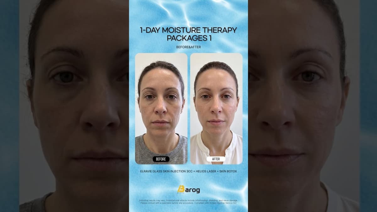 [Gangnam Clinic Seoul: Elravie Glass Skin 3cc + Helios Laser + Skin Botox Before & After✨ ]