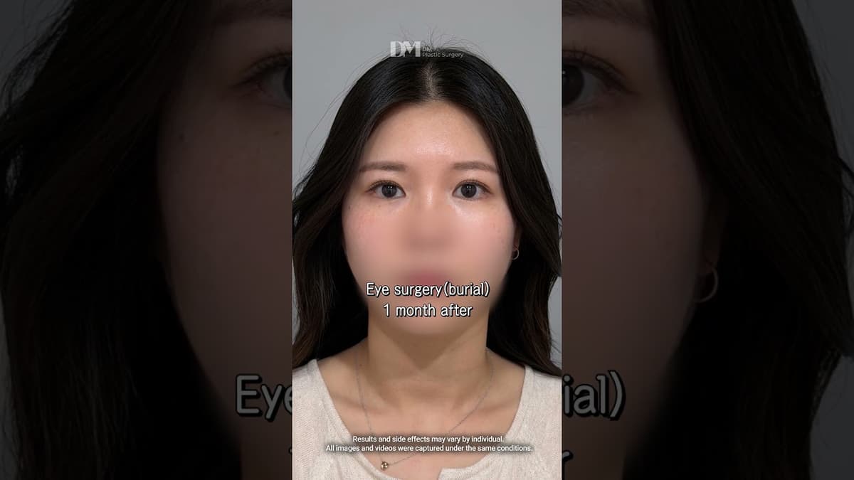 Natural double eyelid surgery? DM is your choice #viral #trending #viralshorts #eyelidsurgeyr #fyp