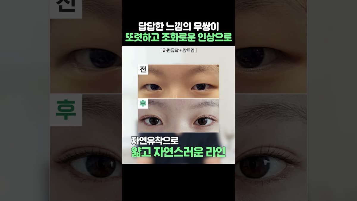 무쌍 자연유착 리얼 후기 #자연유착#앞트임#전후사진