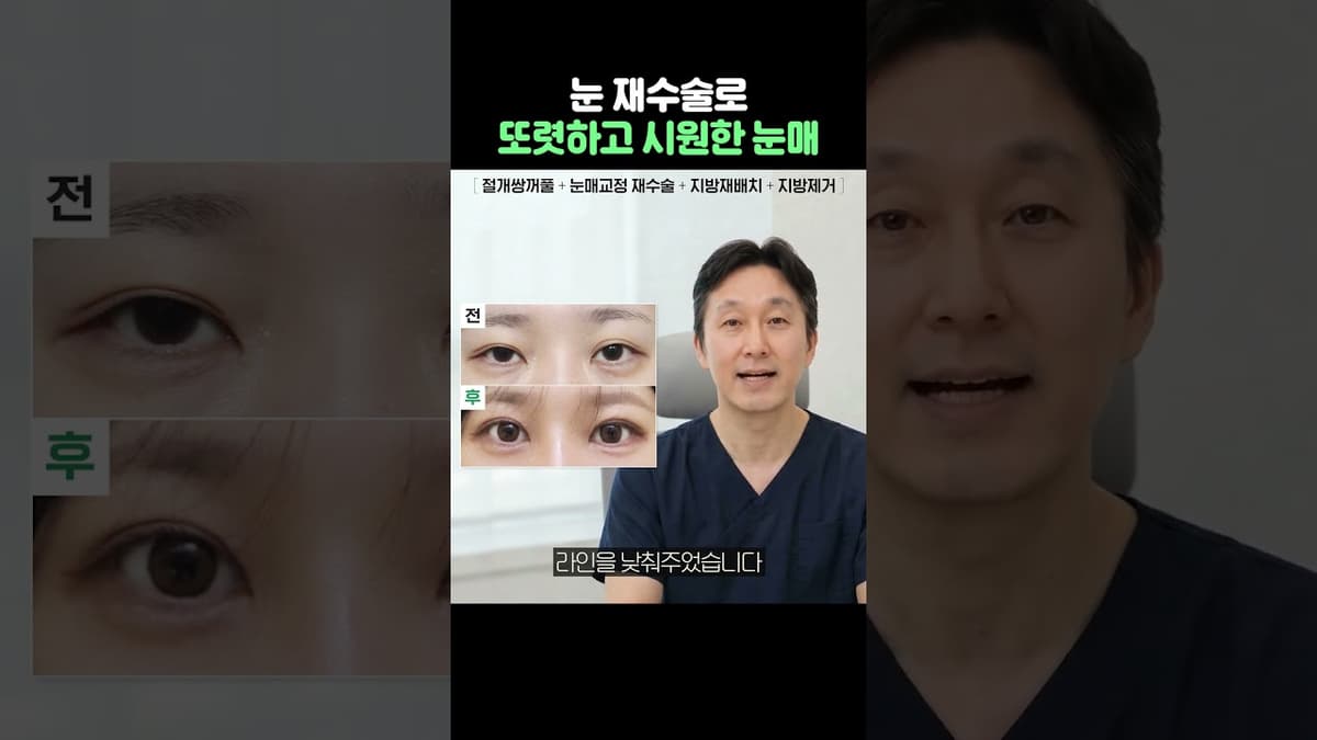 스트레스였던 짝눈 재수술 리얼 후기 #쌍꺼풀재수술#절개쌍수