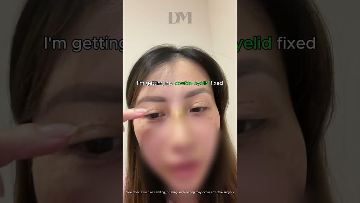 #doubleeyelidsurgery in #seoul #korea would you choose #dmplasticsurgery #beforeafter looks natural💕