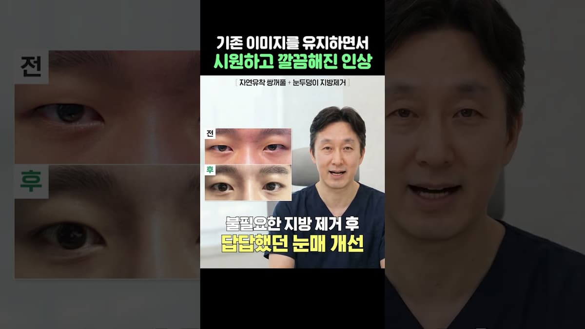 티 안나는 #남자 #쌍꺼풀 전후#자연유착#쌍수#리얼후기