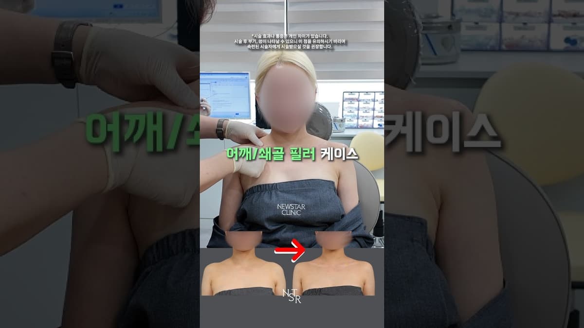 둥근 어깨라인과 쇄골 고민인 케이스