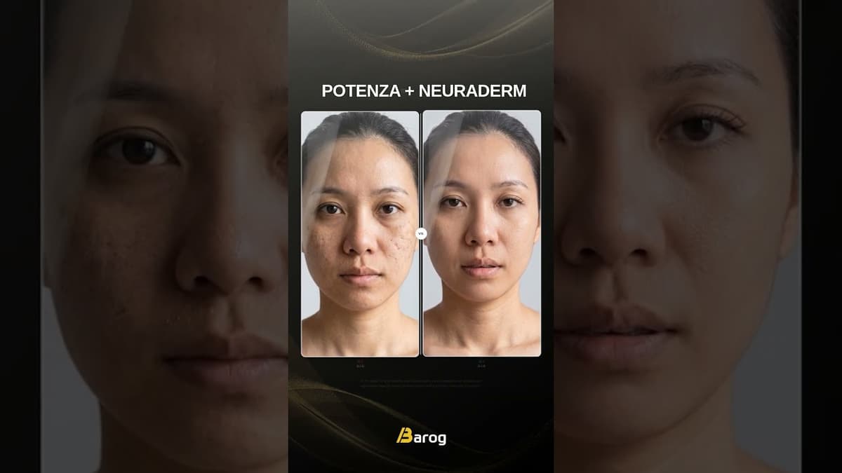 [Gangnam Clinic: Potenza + Neuraderm Before & After✨]