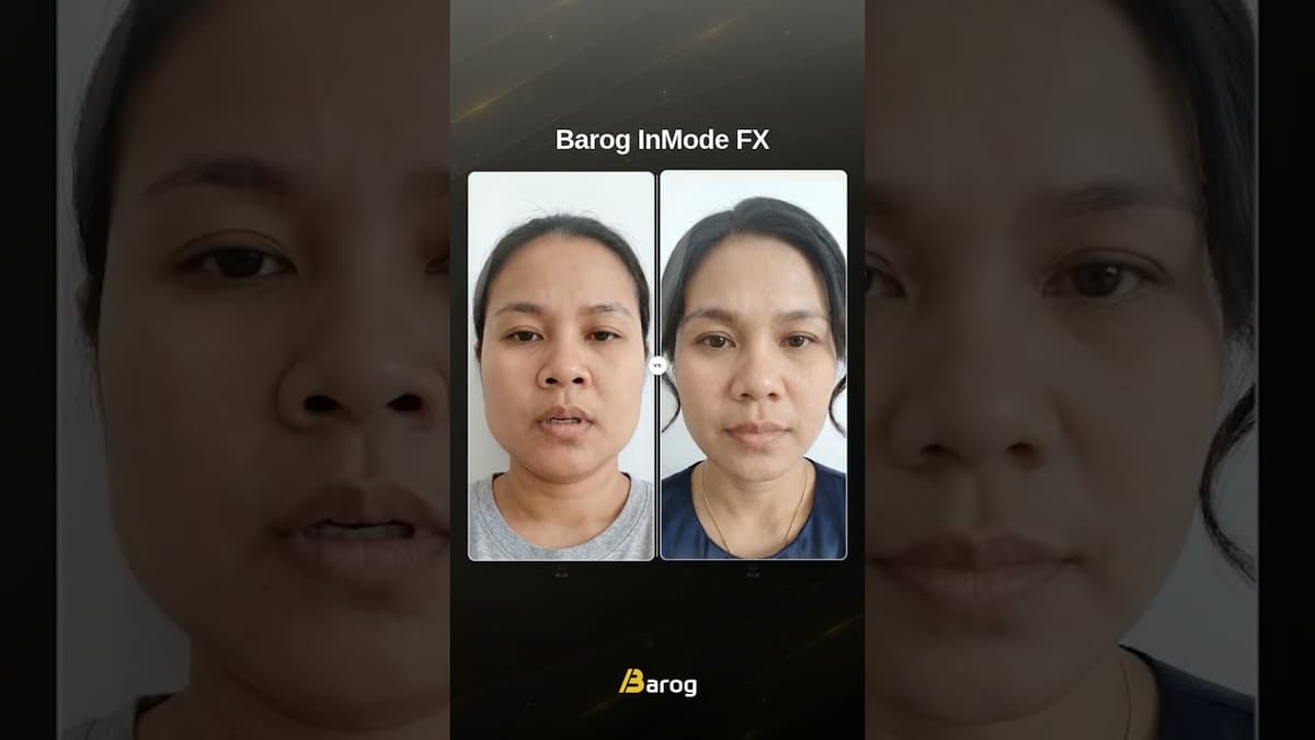 [江南クリニック ソウル：アイインモードFX + フォーマのビフォーアフター✨]
