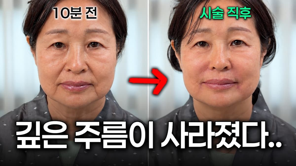 이젠 깊은 주름도 지울 수 있습니다. (팔자주름·입가주름 제거 쥬브젠 시술)