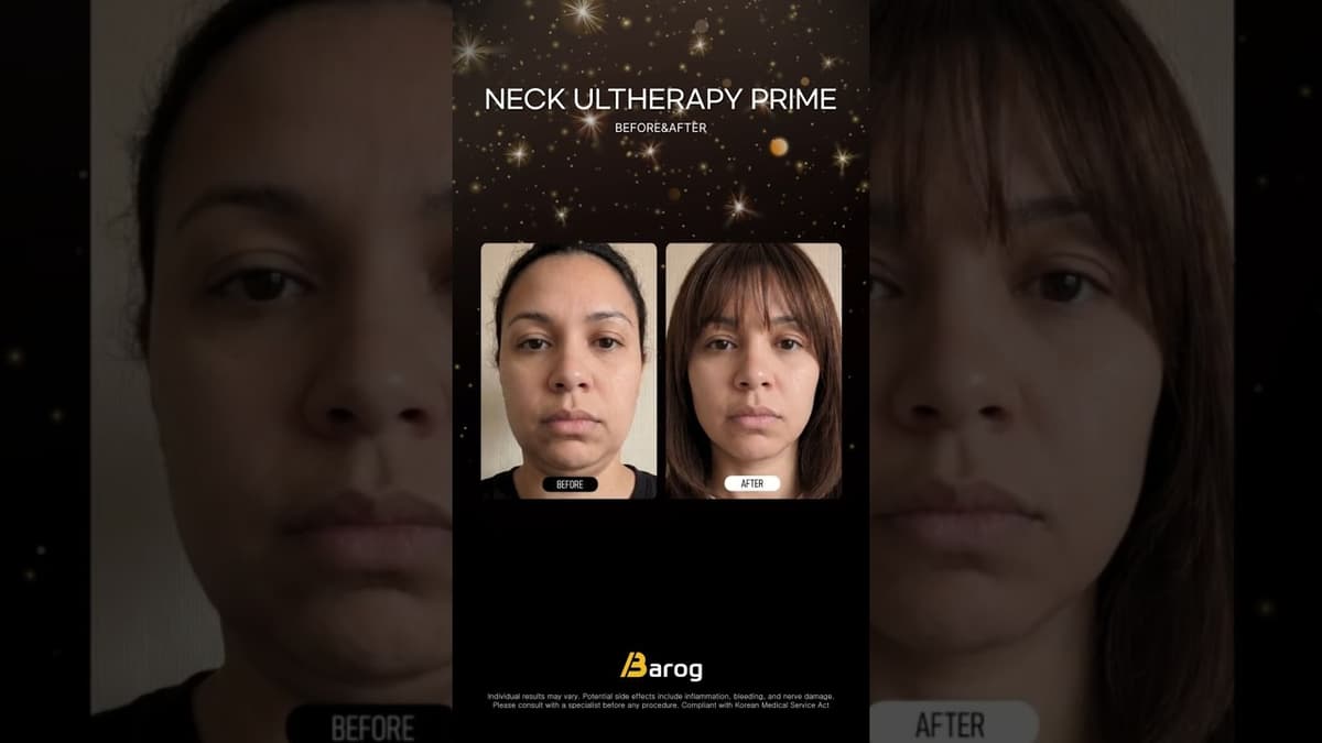 [Clínica Gangnam em Seul: Ultherapy Prime para o pescoço - 100 aplicações - Antes e Depois✨]