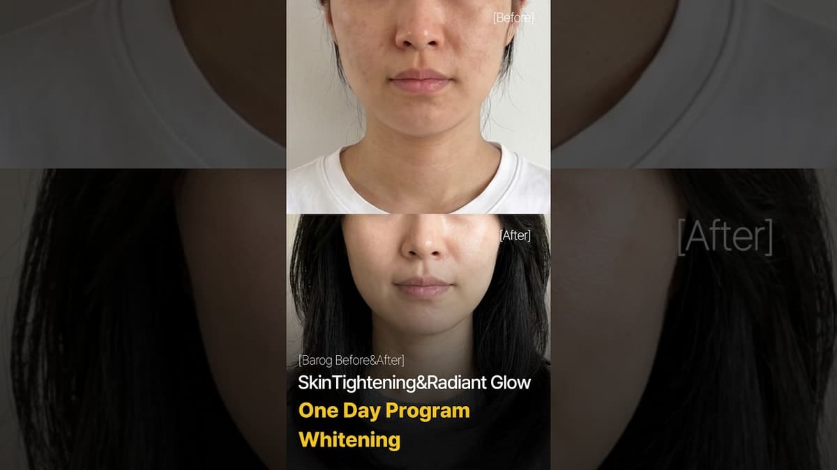[Gangnam Clinic Seoul: One Day Program Whitening  Before & After✨]