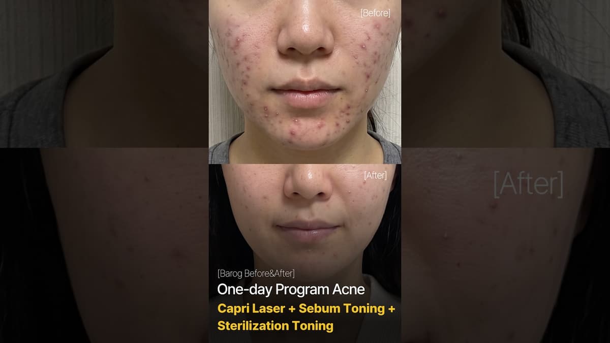 [Clinica Gangnam Seoul: Programma Giornaliero Acne (Laser Capri + 2 Tipi di Toning) Prima & Dopo✨]