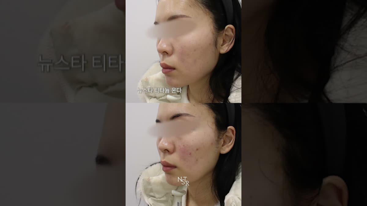 얼굴 처짐이 고민 티타늄, 온다로 리프팅 관리 케이스