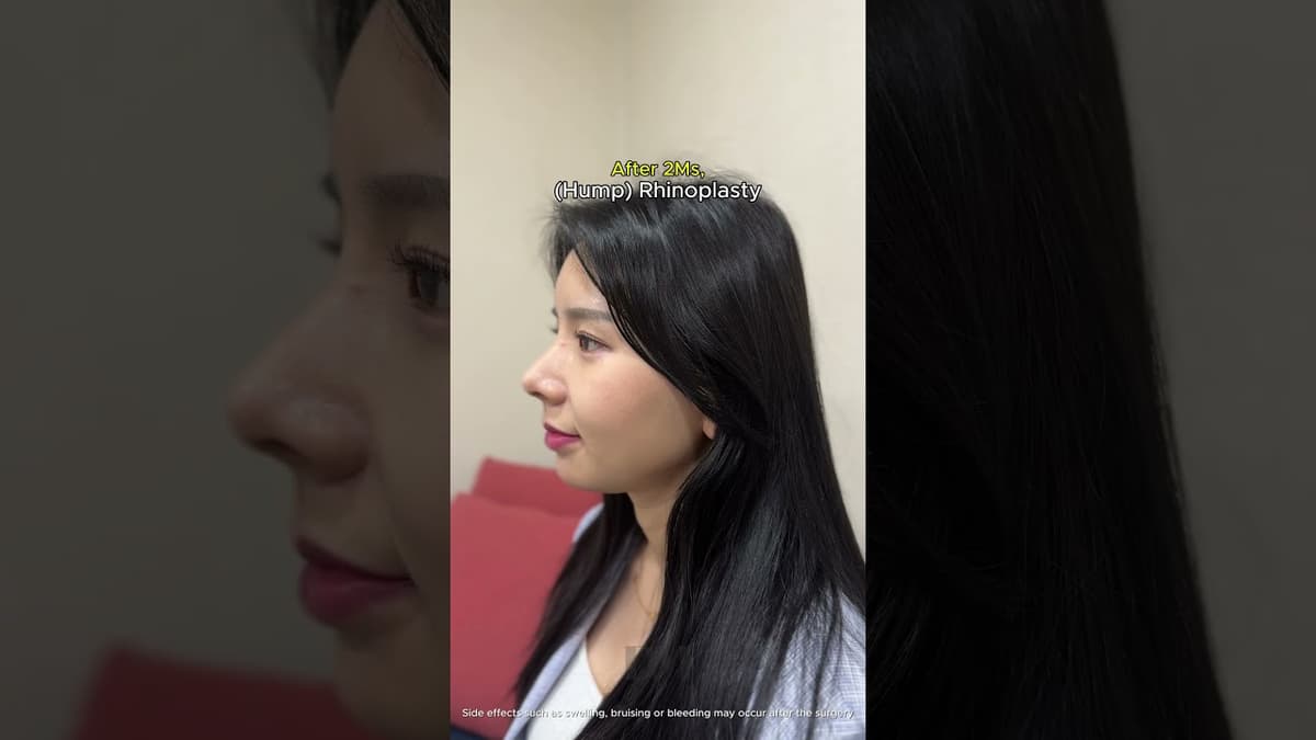Male nose to Female nose transformation #viral #trend #viralshorts #rhinoplasty #nosejob #challenge