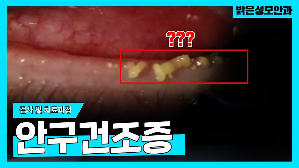 안구건조증 💡검사 및 치료과정💡에 대해 모든 것을 알려드리겠습니다❗️❗️