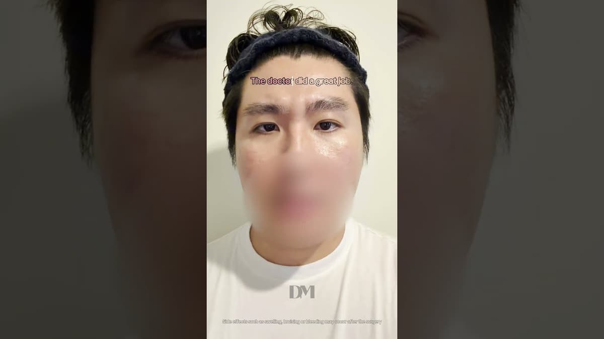 ผู้ชายทำศัลยกรรมตกแต่งไม่ได้เหรอ? #viralshorts #trend #fyp #america #eyesurgery #ptosiscorrection