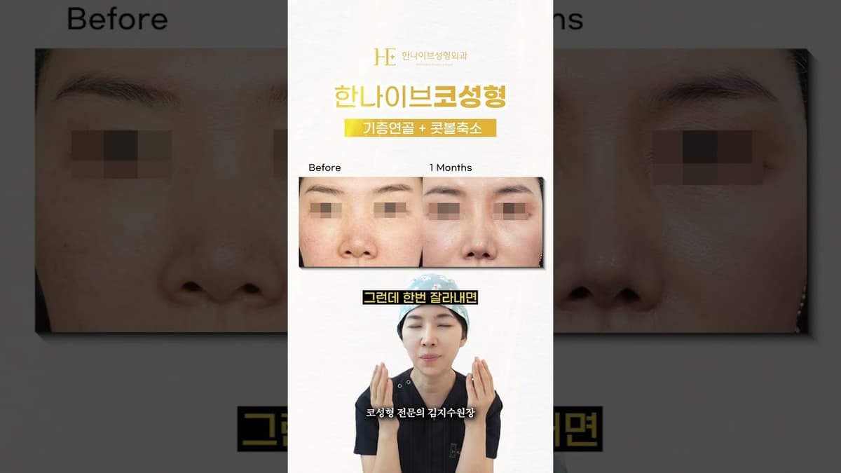 콧볼축소는 신중하게