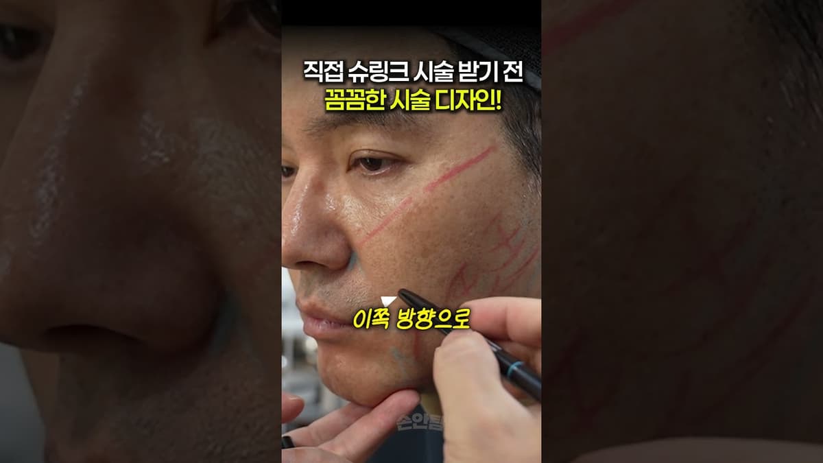 تصميم دقيق للإجراء قبل الخضوع لجلسة "شيرينك" مباشرة! #شيرينك #أولثيرا