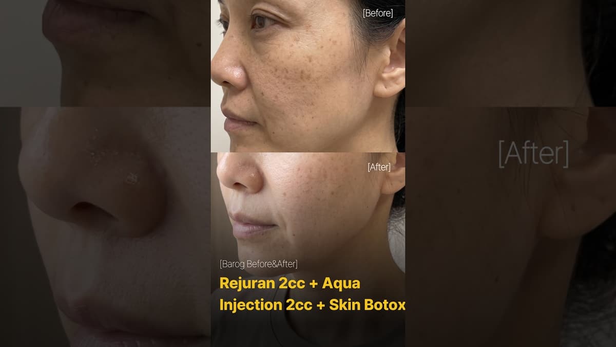 [Клиника Gangnam Сеул: Rejuran 2cc + Aqua Injection 2cc + Скин Ботокс До и После✨]