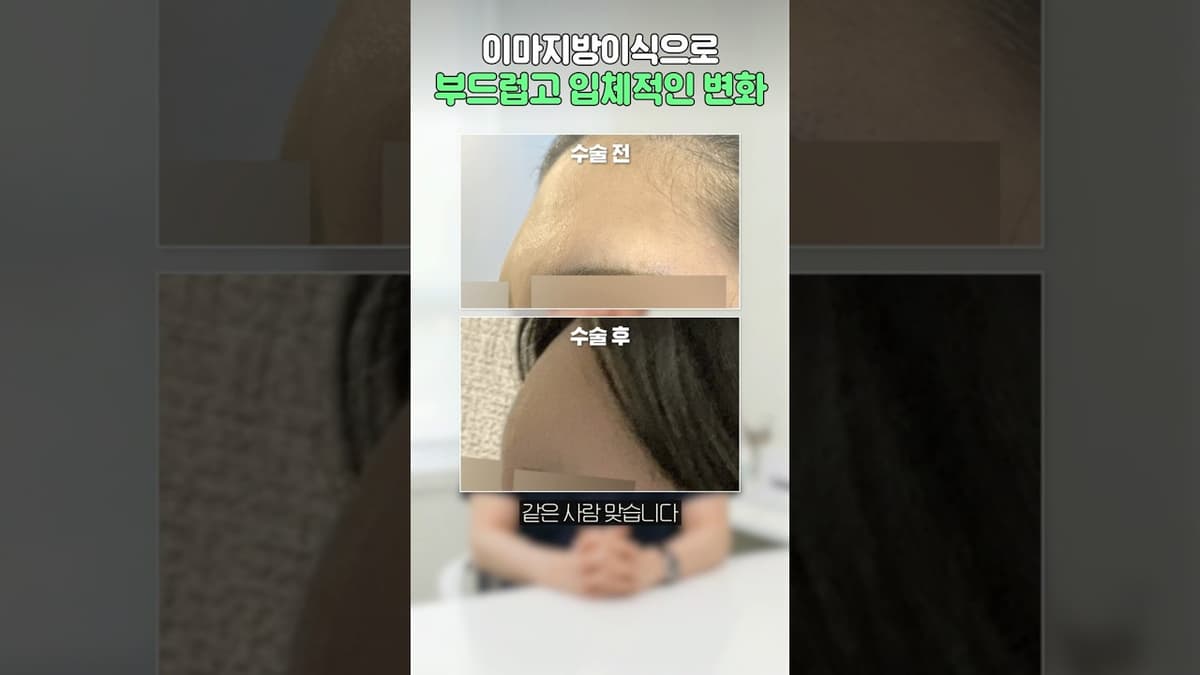 이마지방이식 Before & After｜리얼후기 #Shorts