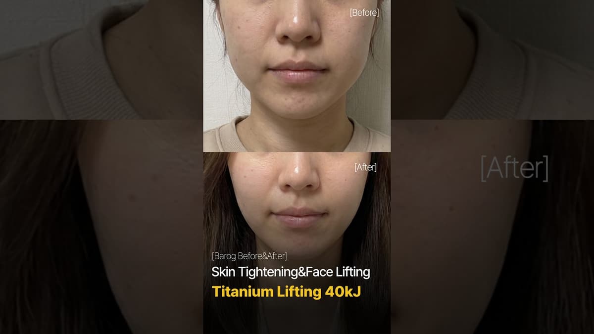 [Gangnam Clinic Seoul: 'titanium 40k' Before & After✨]