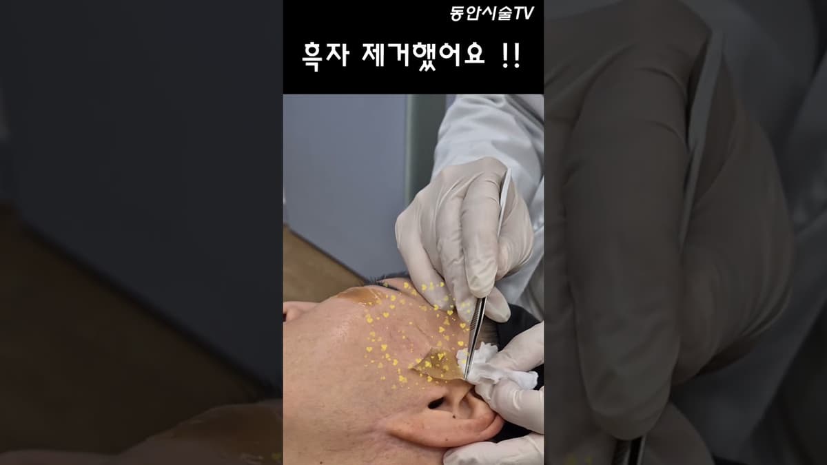 흑자 제거했어요 짜잔~