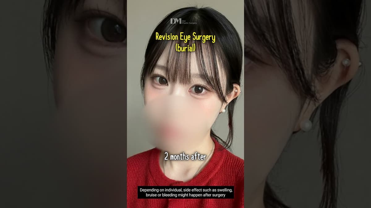 #Revisionsurgery #Eyesurgery , do you think I chose right clinic?  #viral #trend #korea #fyp #seoul