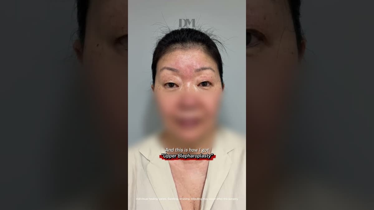 First surgery ever in her life | check out the recovery #fyp #trend #viral #eyesurgerykorea #korea