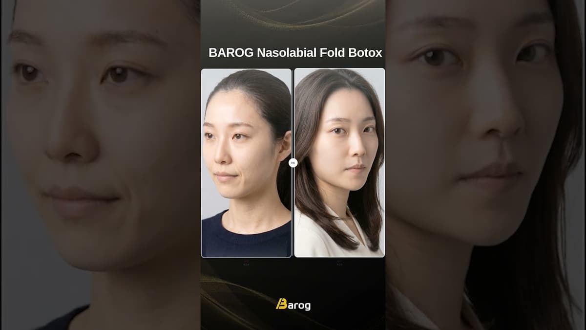 [Gangnam Clinic Seoul: Nasolabial Fold Botox Before & After✨]