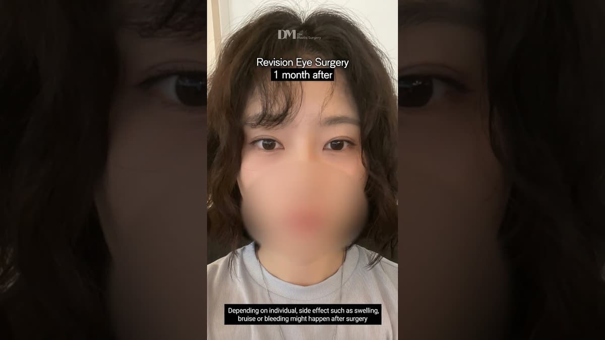 #revisionsurgery at #dmplasticsurgery let's check out her #beforeafter #seoul #kbeauty #trend #viral
