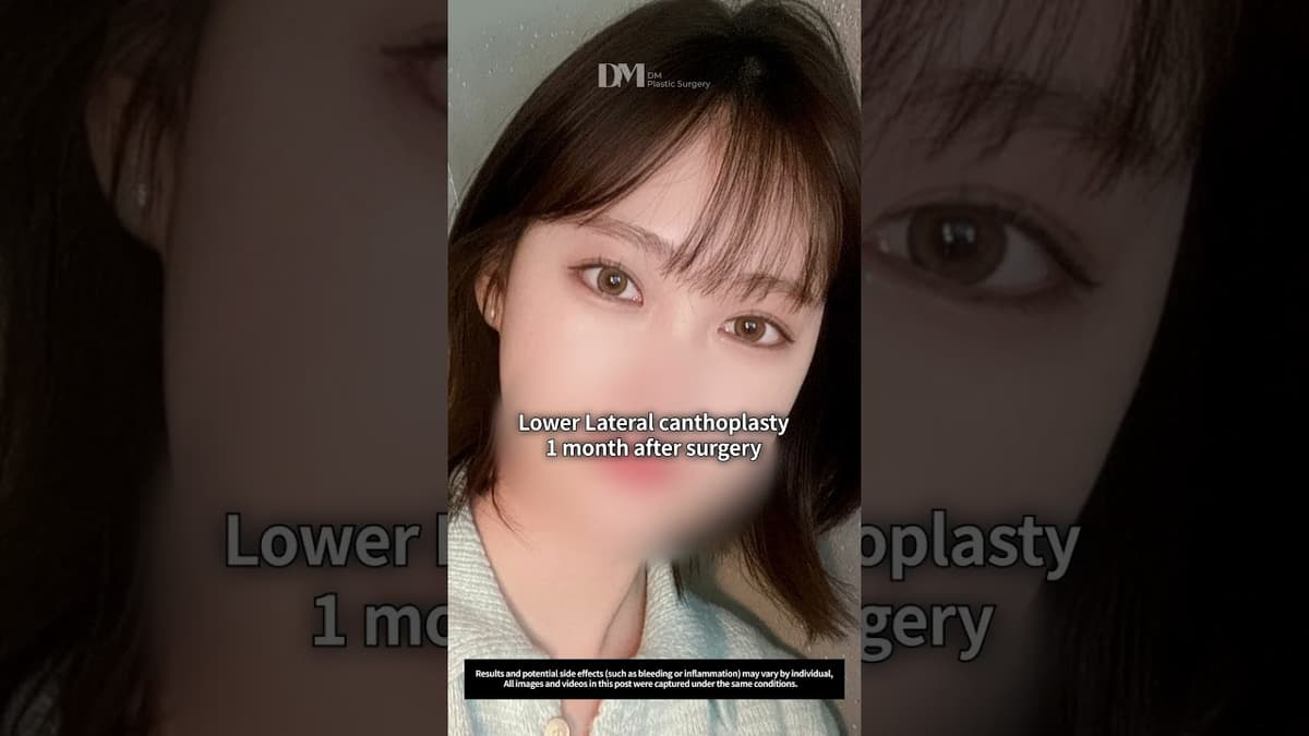 You looking for eye enlargement surgery? #canthoplasty #eyesurgery #korea #seoul #fyp #trend #viral