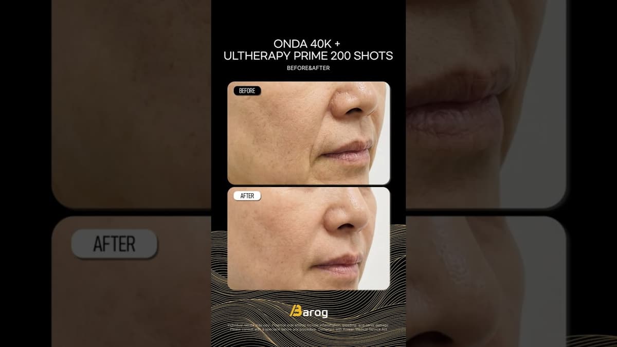 [Gangnam Clinic Seul: ONDA 40K + Ultherapy Prime 200 Atış Öncesi ve Sonrası✨]