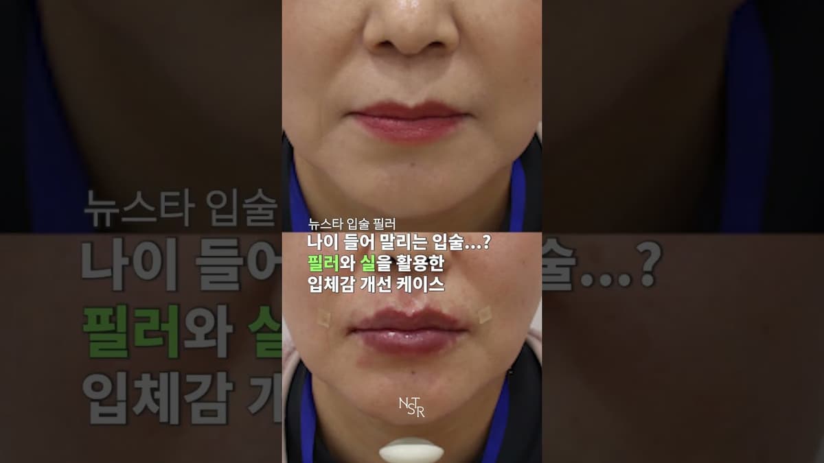 Bibir yang tertarik ke dalam seiring bertambahnya usia