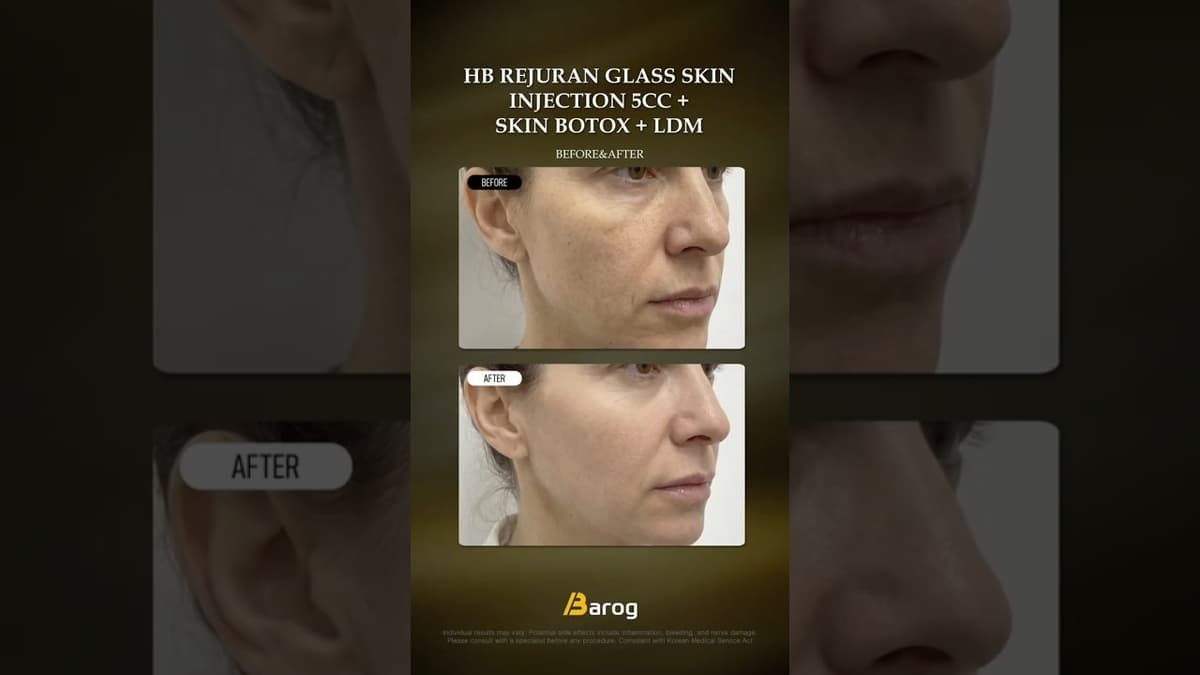 [Gangnam Clinic Seoul: 'HB Rejuran Glass Skin Injection 5cc +Skin Botox + LDM' Before & After✨]