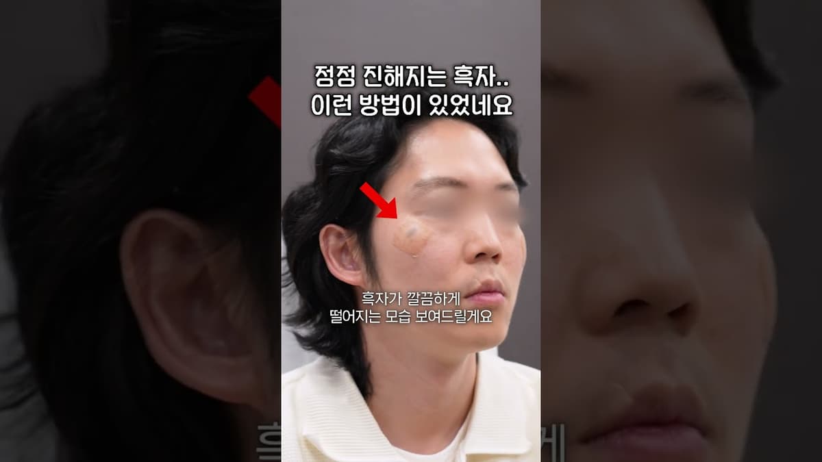 진작 알았으면 좋았을 흑자제거 방법 😲