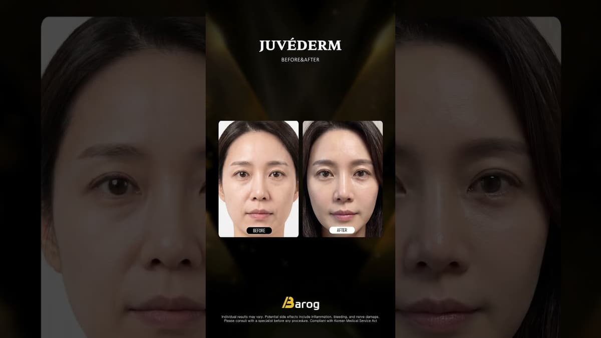 [Gangnam Clinic Seoul: Juvederm Before & After✨]