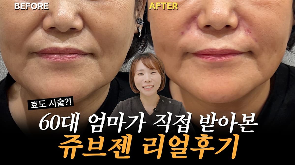 쥬브젠 팔자주름 시술 전 과정 리얼 후기! | 60대 엄마가 직접 받아본 자가진피재생술