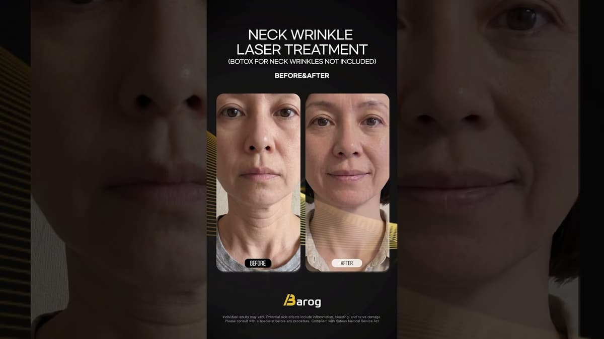 [Gangnam Clinic Seoul: Neck Wrinkle Laser Treatment Before & After✨]